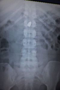 X-ray shows a bullet lodged near the trauma patient’s spine. 
